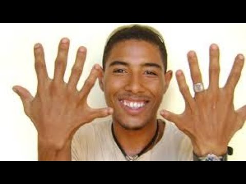 Videos Increíbles 16 / Familia con 6 Dedos en la Mano en Brasil