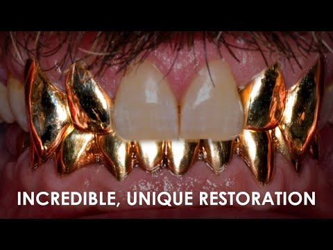 Incredibly, Unique, Patient-Requested Restoration