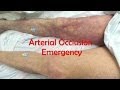 Understanding Blood Vessel Obstruction