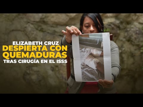 Elizabeth Cruz despierta con quemaduras tras cirugía en el Seguro Social