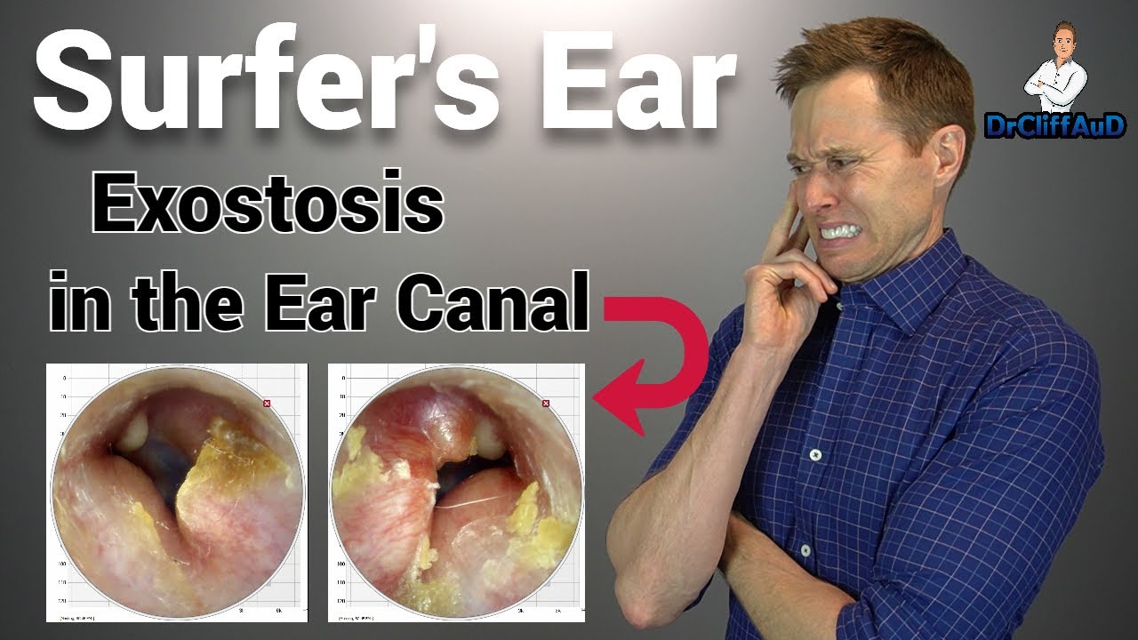 CRAZY Growth in the Ear Canal | Surfer's Ear due to Exostosis