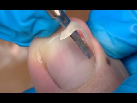 How to repair nails