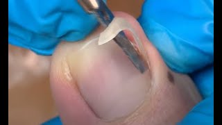 How to repair nails