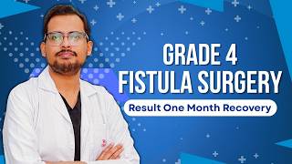 Grade 4 Fistula Surgery Result | One Month Recovery
