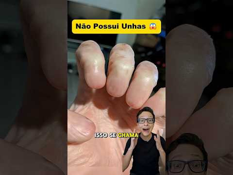 Não Possui Unhas 😱#medicina #medico #enfermagem #enfermeiro #enfermeira #manicure #unhas Anoníquia