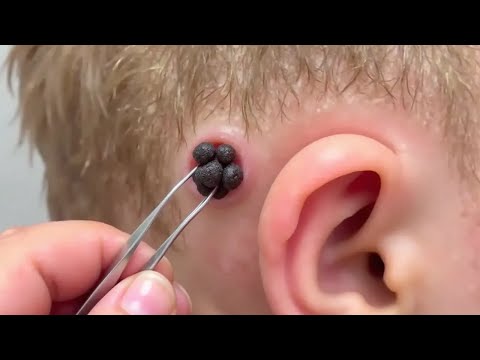 hair transplant gone horribly wrong..