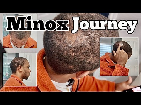 Is My Hair Growing Back Already?! 👀 - 🔥 Week 2 Minoxidil Update