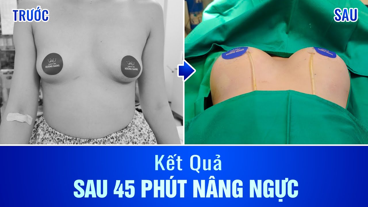 [Kết quả 45 phút] Nâng ngực Nanochip Ergonomix - Ngực đầy đặn, sexy