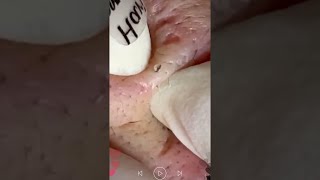 Skincare | Blackheads Removal #462 #tweezers skincare #blackheads blackheads