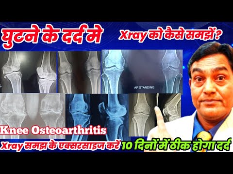 घुटने के दर्द Xray से कैसे समझें कि कौन सा स्टेज का दर्द है । knee osteoarthritis|10 दिनों में ठीक