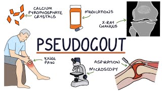Understanding Pseudogout