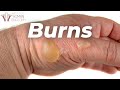 Exploring the Degrees of Skin Burns