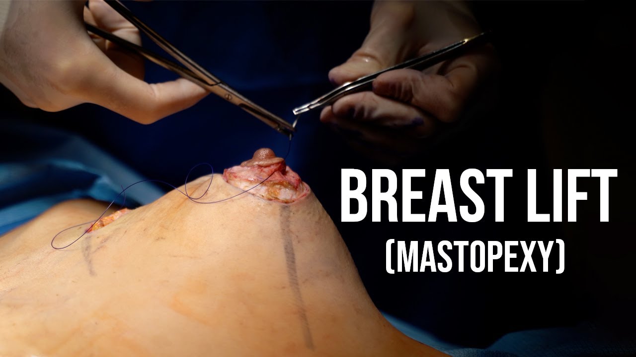 Surgical procedure for breast lift (mastopexy).