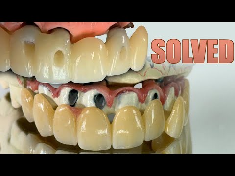 Making a SYTON 7-Star Restoration to Resolve a Difficult Case