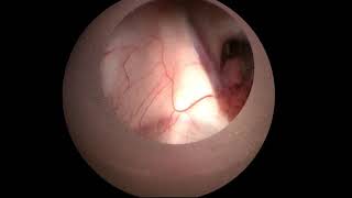 Resection of Intraventricular Arachnoid Cyst Obstructing the Left Foramen of Monro