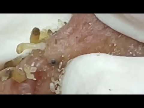 Blackheads & Whiteheads Satisfying Removal @0377