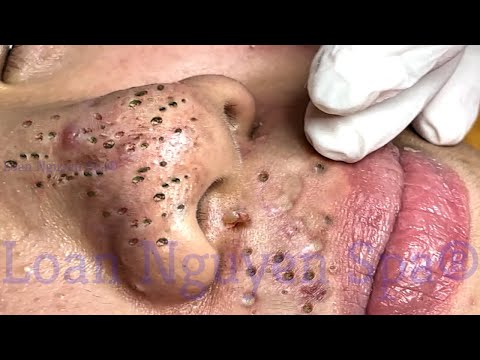 Blackhead Removal With Sac Dep Spa @100074135