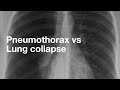 Understanding Lung Conditions and Imaging