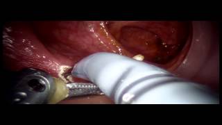 71-1 Robotic TAMIS (Dissection part)