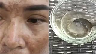 Resep Dokter!! Paling mudah menghilangkan flek menahun sampai tuntas ke akarnya!!