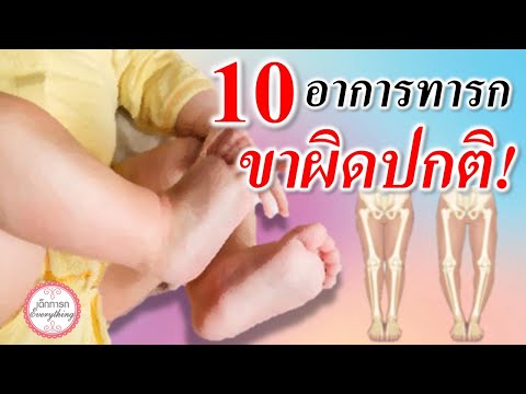อาการทารก-:-10-อาการขาทารกผิดปกติ!--ขาเด็กทารก--เด็กทารก-Eve เด็กทารก Everything Channel อาการทารก : 10 อาการขาทารกผิดปกติ! ขาเด็กทารก เด็กทารก Eve