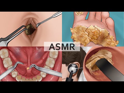 ASMR Collection 2| Remove Large Plantar Warts, Huge Navel Stone, Salivary Gland Stones, Ear Cleaning