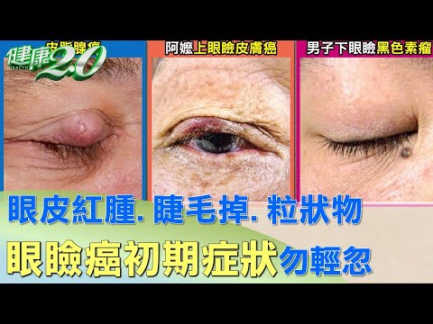 眼皮紅腫、睫毛掉、粒狀物 眼瞼癌初期症狀勿輕忽 健康2.0