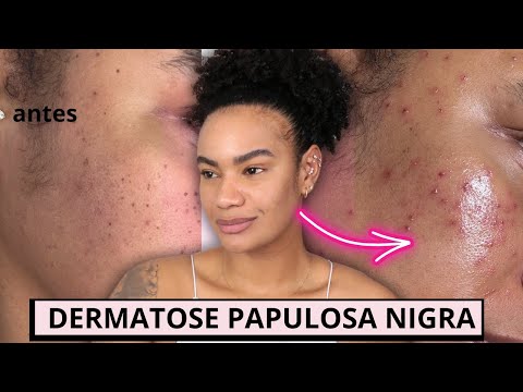 TUDO SOBRE A RETIRADA DA DERMATOSE PAPULOSA NIGRA • Patt Neves