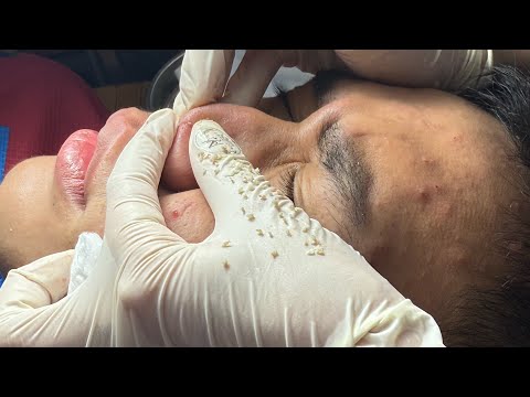 Acne treatment from another angle - Acnes Treatments Mai Ngoc 💕💕💕