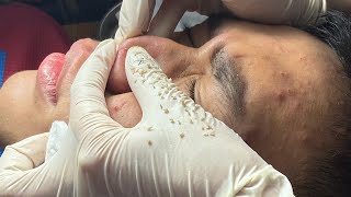 Acne treatment from another angle - Acnes Treatments Mai Ngoc 💕💕💕