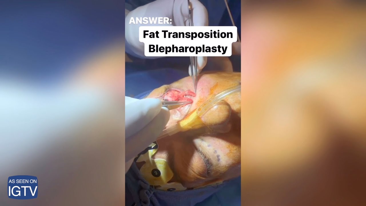 Surgery demonstrating fat transposition blepharoplasty technique.