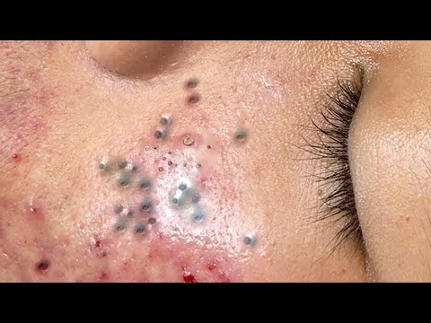 Relax Everyday with Blackheads & Acne Treatment 226