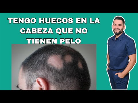 PORQUE SE ME HACEN HUECOS SIN PELO EN LA CABEZA / ALOPECIA AREATA / ALOPECIA | DR. DAVID CAMPOS