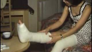 leg cast video in normal day home