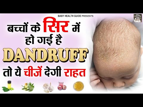 बच्चों के सिर में हो गई है डेंड्रफ, तो ये चीजें देंगी राहत | Dandruff In Kids | Home Remedies 2025