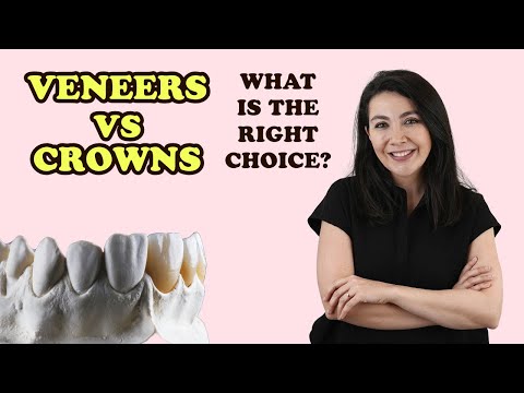 Veneers vs. Crowns: Which Is Right for You? (Expert Guide for Patients!)