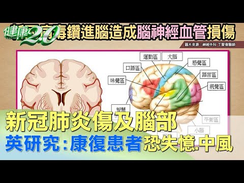 新冠肺炎傷及腦部 英研究:康復患者恐失憶.中風 健康2.0