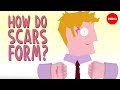 Understanding Scars and Fibrosis