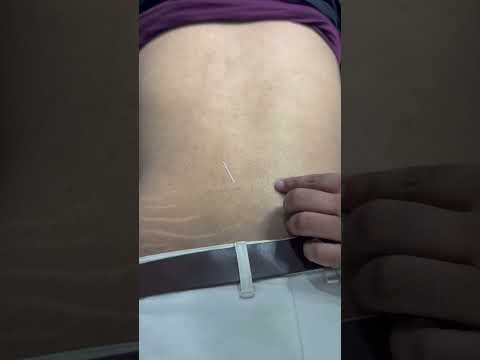 Dryneedling therapy for back pain #dryneedling #ytshorts #backpain #physiotheraphy #terenaina