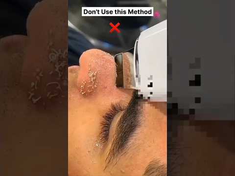 ?Remove Naturally Blackhead & Whitehead ✅ #shorts #youtubeshorts Smbeautylandstudio