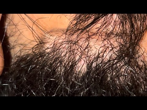 ASMR RELAXATION HAIR | INGROWN HAIR SATISFYING | EPISODE 208