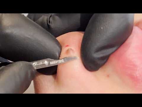CHIN MOLE REMOVAL