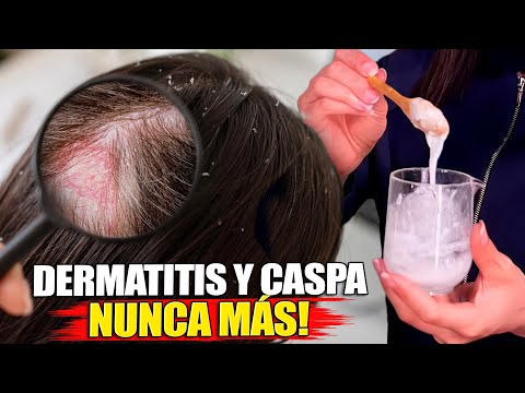 ¡Elimina la DERMATITIS, CASPA y SEBORREA! Receta Rápida y Casera.