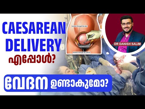 2260 : സിസേറിയൻ  ഡെലിവറി എപ്പോൾ ? വേദന ഉണ്ടാകുമോ ? | Understanding Cesarean Birth