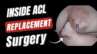 Inside an ACL Surgery: Surgeon’s POV + First Rehab Session