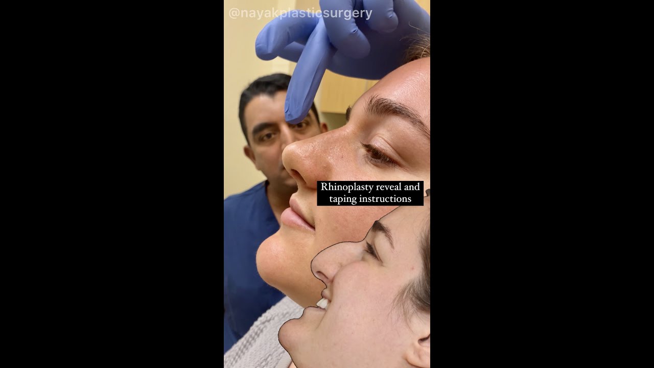 Rhinoplasty consultation with pre and post instructions.