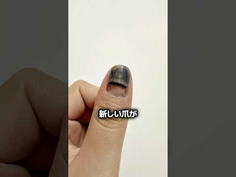 ハンマーで打たれた親指が治癒する過程 👍