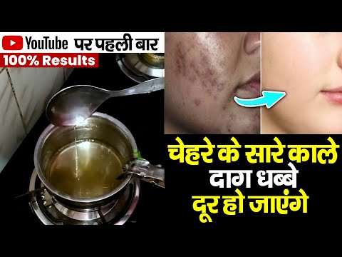 चेहरे के सारे काले दाग़ धब्बे ऐसे होंगे छूमंतर! सिर्फ 5 दिन में फर्क देखें