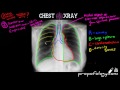 Chest X-Ray Assessment Techniques