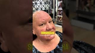 Alopecia Frontal: A Solução que Mudou a Vida Dela!